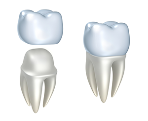 Dental Crowns | Dentist in Stamford, CT | Merritt Dental Care
